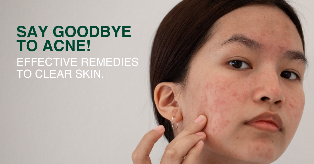 Say Goodbye to Acne- Proven Tips for Clearer Skin