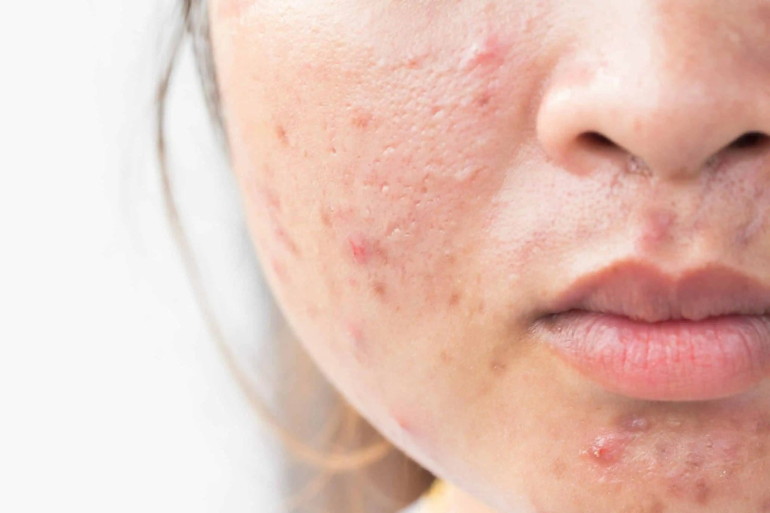 Natural Acne Treatment for Women - Effective DIY Solutions for Clear Skin