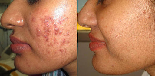 Effective Pimple Treatments- Clear Skin Starts Here